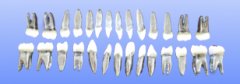 金属根树脂冠恒牙模型